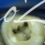 Особенности лечения пульпита у трехканального зуба