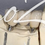 Установка имплантов при отсутствии зубов
